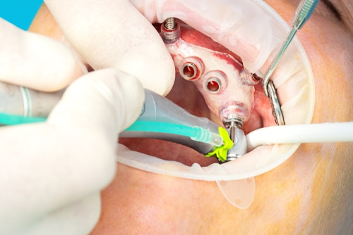 Mini-Dental-Implant-Treatment.