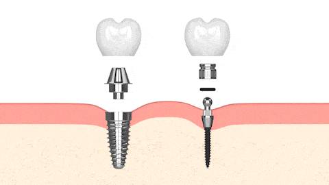 Mini Dental Implants | Mini Dental Implant Center in Winthrop, NY